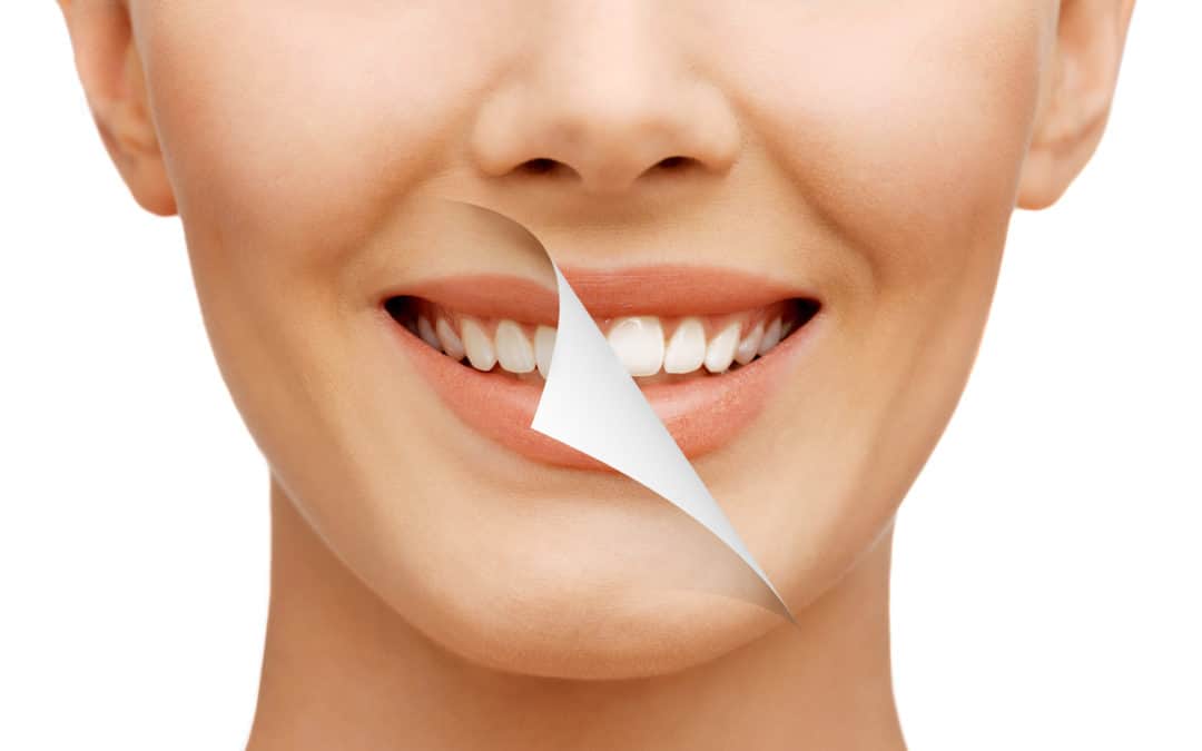 The Benefits of Going to a Teeth Whitening Dentist