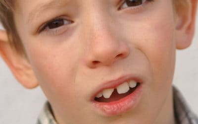 What to Do When a Child Breaks a Permanent Tooth