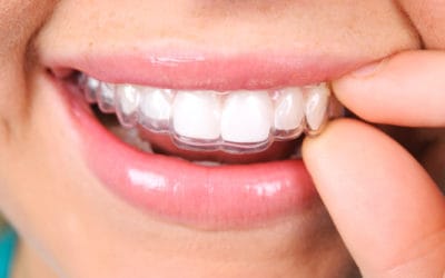 The pros and cons of Invisalign vs braces