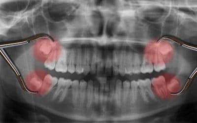 Can a Dentist Do Wisdom Teeth Removal in Phoenix?