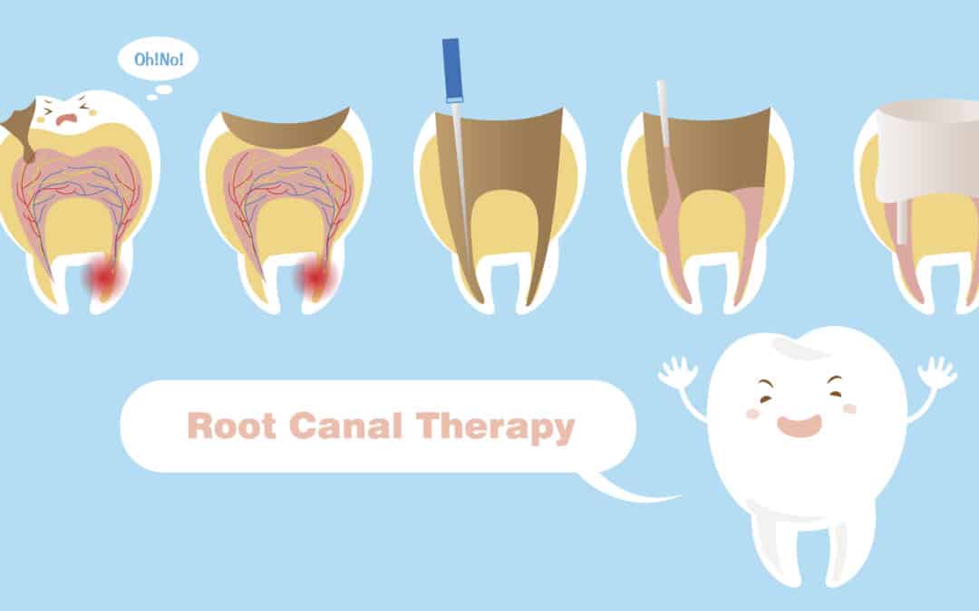 How Serious Is A Root Canal Procedure? What You Need To Know