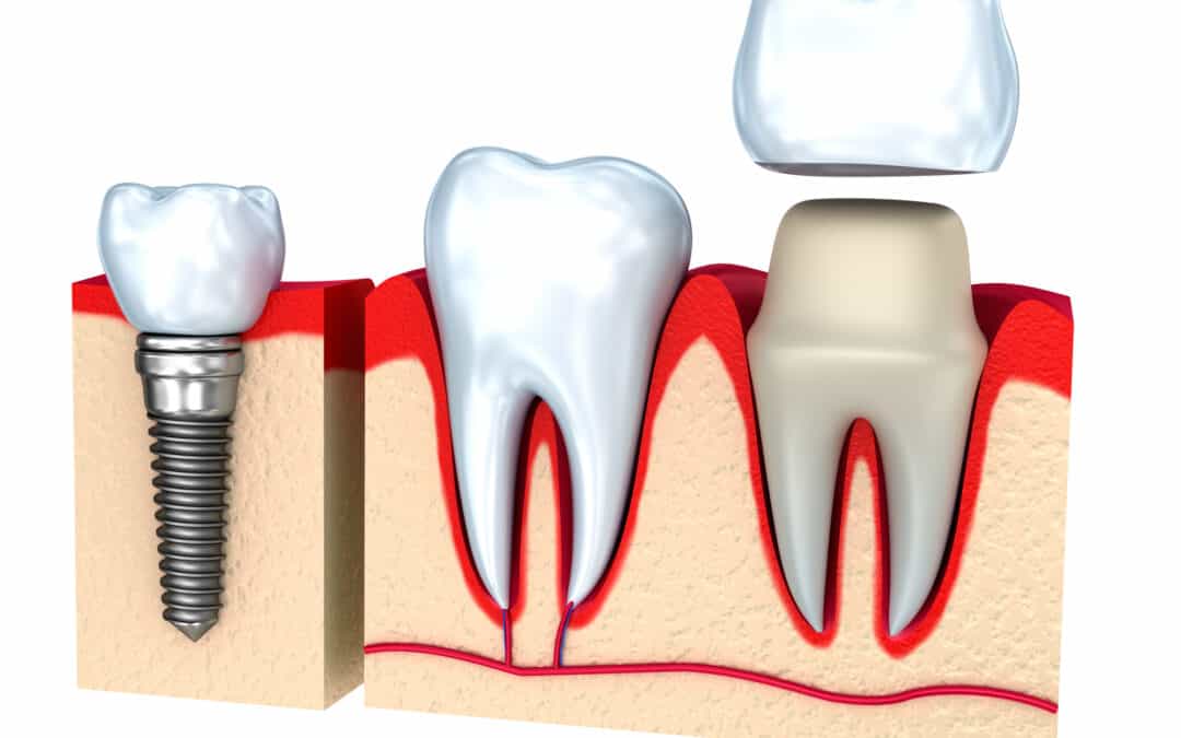 How Much Do Dental Crowns Cost in Phoenix?
