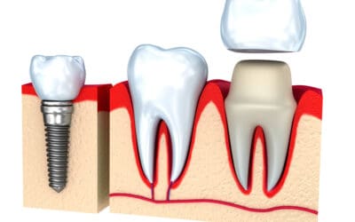 How Much Do Dental Crowns Cost in Phoenix?